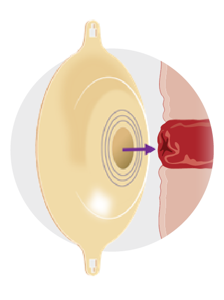 Position skin barrier above flush stoma