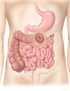 Transverse Colostomy