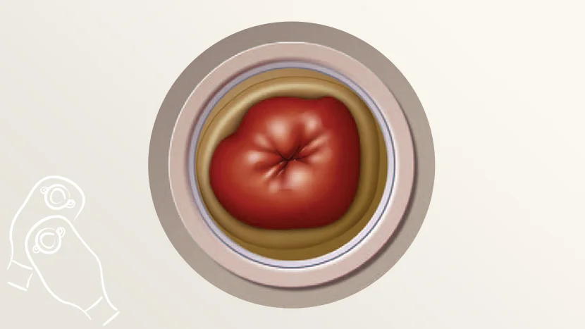 Ihr Stoma verstehen