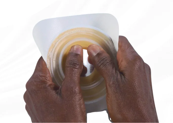 hands molding a moldable skin barrier